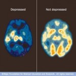 Mayo Clinic PET scan of normal and depressed brains